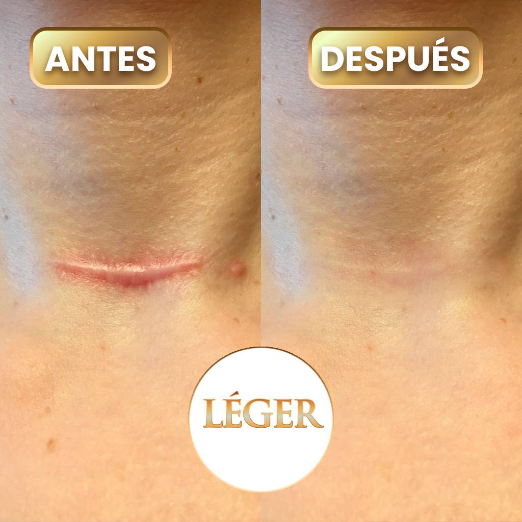 antes-des´pues-leger-2