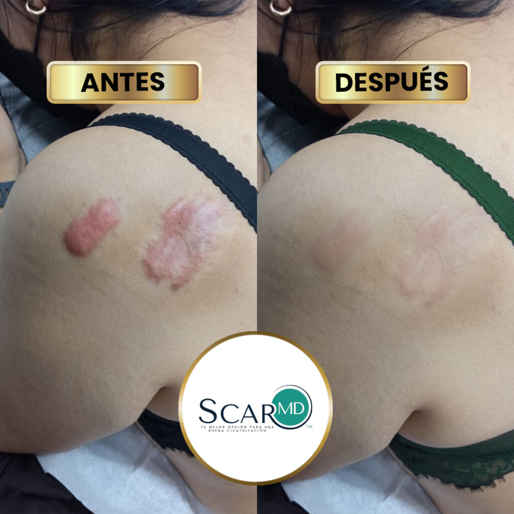 scar antes y dspues 1