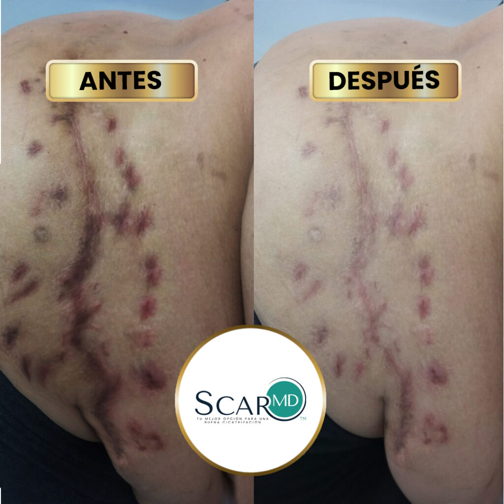 scar antes y dspues 3